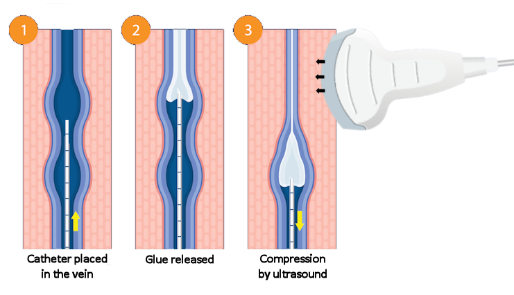 Illustration of adhesive used to treat varicose veins