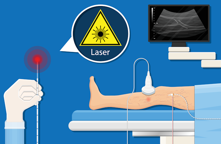 Using ultrasound the laser is placed in the varicose vein