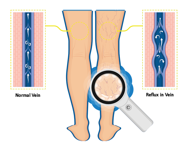 Normal vein and varicose vein showing reflux of blood