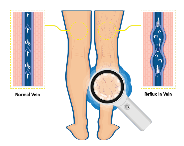 Varicose Veins Simply Explained