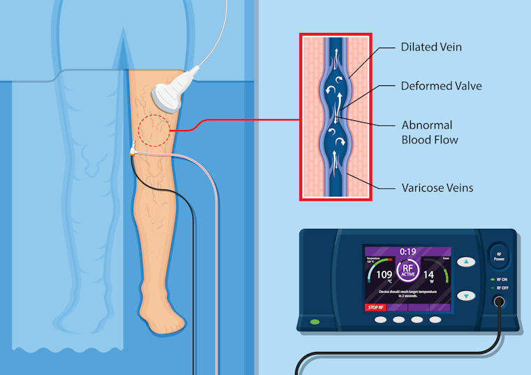 Using ultrasound the RFA catheter is placed in the varicose vein