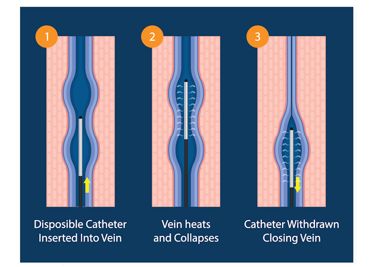 RFA treatment of Varicose Veins