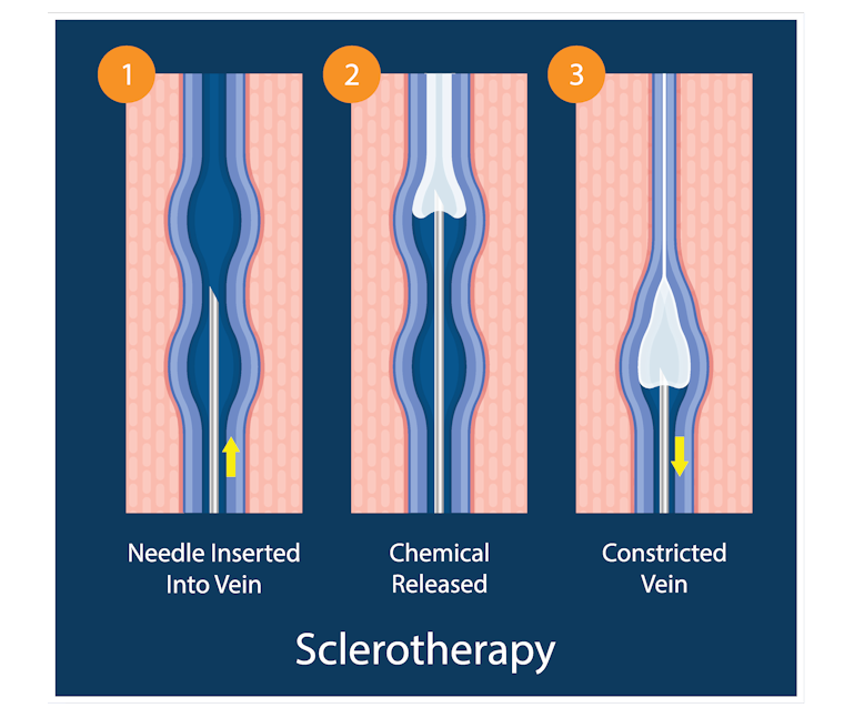 Sclerosant is injected into the
                    varicose vein and compression stockings applied