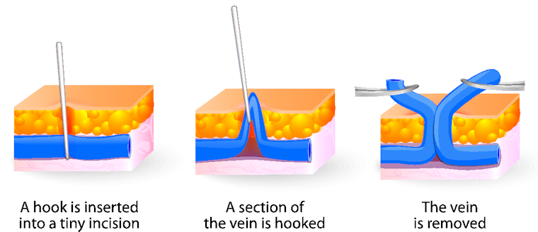 Illustration of varicose vein being surgically removed