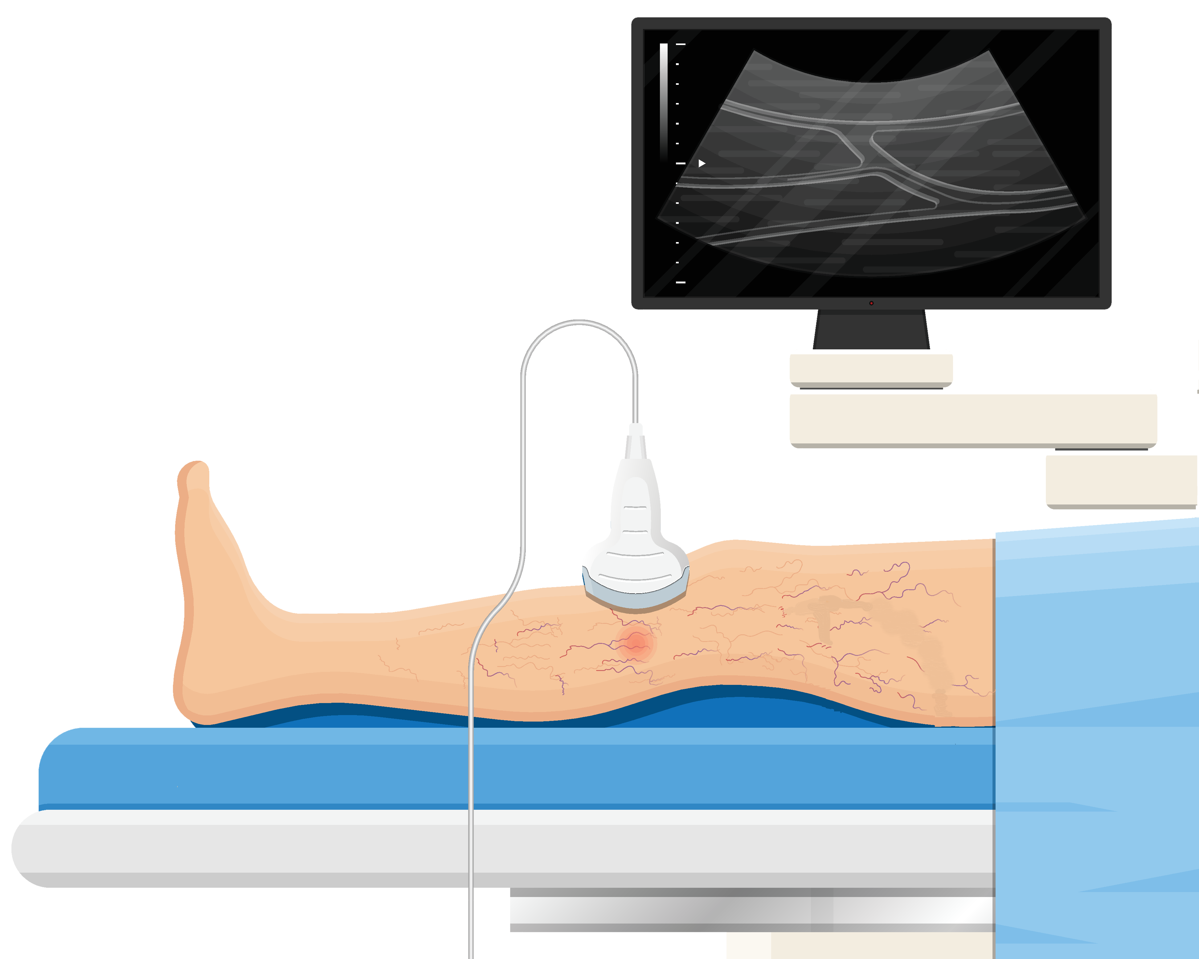 Ultrasound of the leg for varicose veins